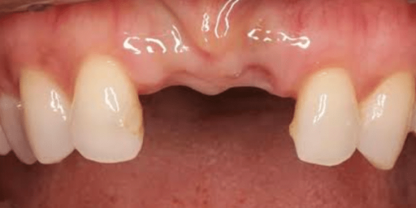 dental-implant-before-1-san-clemente