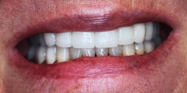 full-mouth-reconstruction-after-1-san-clemente