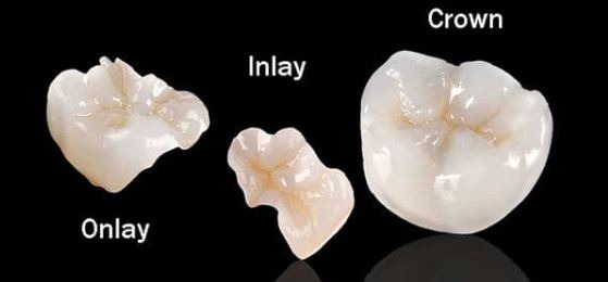 Inlays & Onlays – Oceansight Dental & Implants