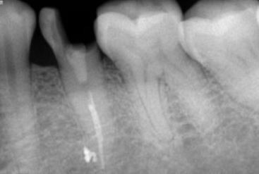 Inlays & Onlays – Oceansight Dental & Implants